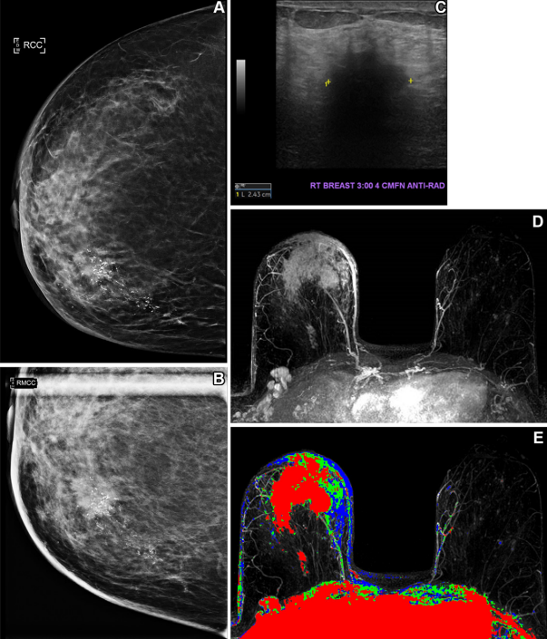 Health insurance coverage influences breast cancer screening behavior. In one case, a 61-year-old uninsured woman with no known previous screening for breast cancer presented for screening mammography. (A) A craniocaudal two-dimensional synthetic mammogram of the right breast shows an irregular mass in the medial breast with pleomorphic calcifications extending posteriorly. (B) A craniocaudal magnified mammogram more clearly shows the irregular mass and pleomorphic calcifications in the medial breast. (C) An anti-radial ultrasound image of the right breast shows an irregular hypoechoic mass with indistinct margins and posterior acoustic shadowing at the 3 o'clock position, approximately 4 cm from the nipple. (D) An axial postcontrast maximum intensity projection (MIP) subtracted MR image shows a large enhancing mass in the anterior and medial right breast with skin thickening and enhancement and several morphologically abnormal right axillary lymph nodes. (E) An axial postcontrast MIP subtracted MR image with color mapping shows the rapidly enhancing mass with washout kinetic enhancement in the anterior and medial right breast, with skin thickening and enhancement and several morphologically abnormal right axillary lymph nodes. Histopathologic biopsy results demonstrated invasive mammary carcinoma with metastatic disease in a right axillary lymph node. Image courtesy of Peter Abraham, MD, et al.