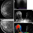 Health insurance coverage influences breast cancer screening behavior. In one case, a 61-year-old uninsured woman with no known previous screening for breast cancer presented for screening mammography. (A) A craniocaudal two-dimensional synthetic mammogram of the right breast shows an irregular mass in the medial breast with pleomorphic calcifications extending posteriorly. (B) A craniocaudal magnified mammogram more clearly shows the irregular mass and pleomorphic calcifications in the medial breast. (C) An anti-radial ultrasound image of the right breast shows an irregular hypoechoic mass with indistinct margins and posterior acoustic shadowing at the 3 o'clock position, approximately 4 cm from the nipple. (D) An axial postcontrast maximum intensity projection (MIP) subtracted MR image shows a large enhancing mass in the anterior and medial right breast with skin thickening and enhancement and several morphologically abnormal right axillary lymph nodes. (E) An axial postcontrast MIP subtracted MR image with color mapping shows the rapidly enhancing mass with washout kinetic enhancement in the anterior and medial right breast, with skin thickening and enhancement and several morphologically abnormal right axillary lymph nodes. Histopathologic biopsy results demonstrated invasive mammary carcinoma with metastatic disease in a right axillary lymph node. Image courtesy of Peter Abraham, MD, et al.