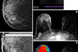 Health insurance coverage influences breast cancer screening behavior. In one case, a 61-year-old uninsured woman with no known previous screening for breast cancer presented for screening mammography. (A) A craniocaudal two-dimensional synthetic mammogram of the right breast shows an irregular mass in the medial breast with pleomorphic calcifications extending posteriorly. (B) A craniocaudal magnified mammogram more clearly shows the irregular mass and pleomorphic calcifications in the medial breast. (C) An anti-radial ultrasound image of the right breast shows an irregular hypoechoic mass with indistinct margins and posterior acoustic shadowing at the 3 o'clock position, approximately 4 cm from the nipple. (D) An axial postcontrast maximum intensity projection (MIP) subtracted MR image shows a large enhancing mass in the anterior and medial right breast with skin thickening and enhancement and several morphologically abnormal right axillary lymph nodes. (E) An axial postcontrast MIP subtracted MR image with color mapping shows the rapidly enhancing mass with washout kinetic enhancement in the anterior and medial right breast, with skin thickening and enhancement and several morphologically abnormal right axillary lymph nodes. Histopathologic biopsy results demonstrated invasive mammary carcinoma with metastatic disease in a right axillary lymph node. Image courtesy of Peter Abraham, MD, et al.