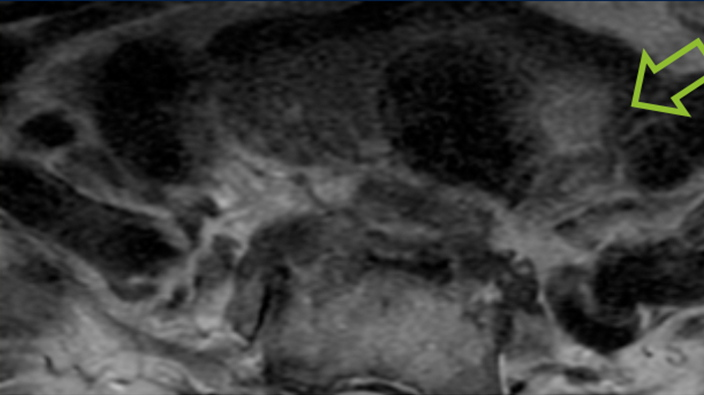 Incidental imaging finding. Image courtesy of Hailey Choi, MD, of the University of California, San Francisco.