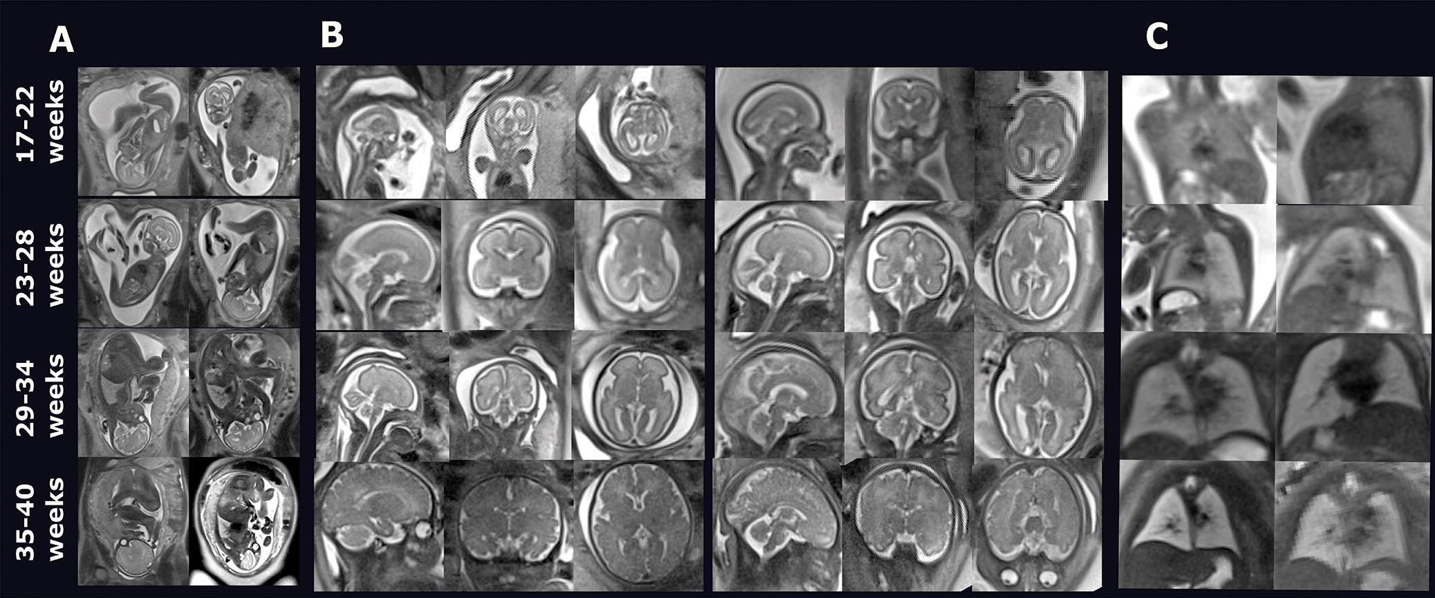 Images show fetal T2-weighted fast-spin-echo 0.55-T MRI scans at various gestational ages. (A) Miduterine coronal anatomic views from eight representative healthy pregnant participants (scans in control group); (B) planned brain views in sagittal, coronal, and axial orientation from eight representative healthy pregnant participants (scans in control participants); and (C) lung views from eight representative healthy pregnant participants (scans in control group). The scans are shown in four gestational age ranges.