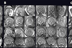 Images show fetal T2-weighted fast-spin-echo 0.55-T MRI scans at various gestational ages. (A) Miduterine coronal anatomic views from eight representative healthy pregnant participants (scans in control group); (B) planned brain views in sagittal, coronal, and axial orientation from eight representative healthy pregnant participants (scans in control participants); and (C) lung views from eight representative healthy pregnant participants (scans in control group). The scans are shown in four gestational age ranges.