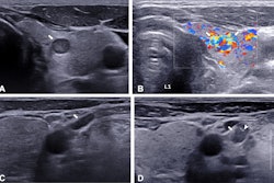 Progression of hypervascular tumor with lymph node metastasis in a 64-year-old male participant with papillary thyroid microcarcinoma. (A-C) Baseline ultrasound images. (A) Transverse gray-scale image shows a solid hypoechoic thyroid nodule (arrow) with a maximal diameter of 7 mm. (B) Color Doppler image shows hypervascularity, represented by increased vascularity above that of normal thyroid parenchyma (arrows). (C) Transverse gray-scale image shows a small, probably benign lymph node at left level IV (arrow). (D) Transverse ultrasound image at 12-month follow-up demonstrates a suspicious lymph node (arrow) with increased shortest diameter and punctate echogenic foci (arrowhead). Subsequent fine-needle aspiration for this level IV lymph node revealed a metastatic thyroid papillary carcinoma. Image courtesy of Radiology.