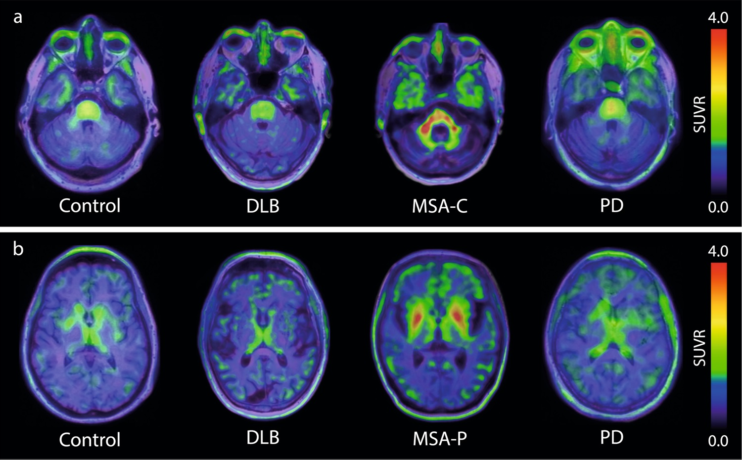 F-18 ACI-12589 PET in participants with &alpha;-synucleinopathies