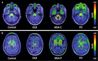 F-18 ACI-12589 PET in participants with α-synucleinopathies