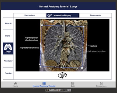 Normal chest anatomy tutorial on CTisus Chest Atlas 3D CRT. Image courtesy of Elliot Fishman, MD.
