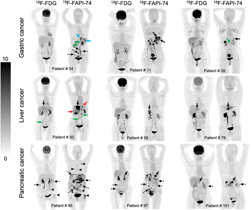 Nine representative patients who underwent F-18 FDG and F-18 FAPI-74 PET imaging. F-18 FAPI-74 PET outperforms F-18 FDG-PET in detecting primary tumors (patients 11, 39, 50, 58, 79, and 101; solid black arrows), local recurrences (patient 4; blue arrows), abdomen LN metastases (patients 4 and 50; green arrows), intrahepatic metastases (patient 50; red arrows), bone metastases (patient 85; arrowheads), and peritoneal metastases (patients 4, 11, 85, 97, and 101; dotted arrows). Image courtesy of the Journal of Nuclear Medicine.