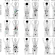 Nine representative patients who underwent F-18 FDG and F-18 FAPI-74 PET imaging. F-18 FAPI-74 PET outperforms F-18 FDG-PET in detecting primary tumors (patients 11, 39, 50, 58, 79, and 101; solid black arrows), local recurrences (patient 4; blue arrows), abdomen LN metastases (patients 4 and 50; green arrows), intrahepatic metastases (patient 50; red arrows), bone metastases (patient 85; arrowheads), and peritoneal metastases (patients 4, 11, 85, 97, and 101; dotted arrows). Image courtesy of the Journal of Nuclear Medicine.