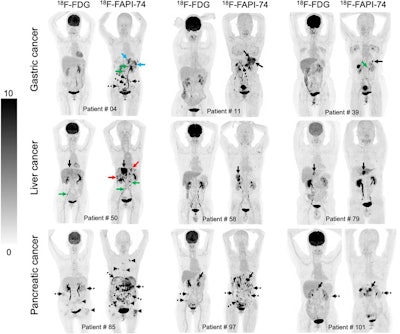 Nine representative patients who underwent F-18 FDG and F-18 FAPI-74 PET imaging. F-18 FAPI-74 PET outperforms F-18 FDG-PET in detecting primary tumors (patients 11, 39, 50, 58, 79, and 101; solid black arrows), local recurrences (patient 4; blue arrows), abdomen LN metastases (patients 4 and 50; green arrows), intrahepatic metastases (patient 50; red arrows), bone metastases (patient 85; arrowheads), and peritoneal metastases (patients 4, 11, 85, 97, and 101; dotted arrows). Image courtesy of the Journal of Nuclear Medicine.