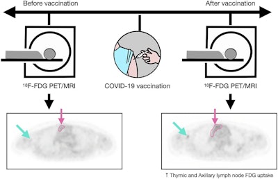 A graphic abstract describing the study. Image courtesy of the Journal of Nuclear Medicine.