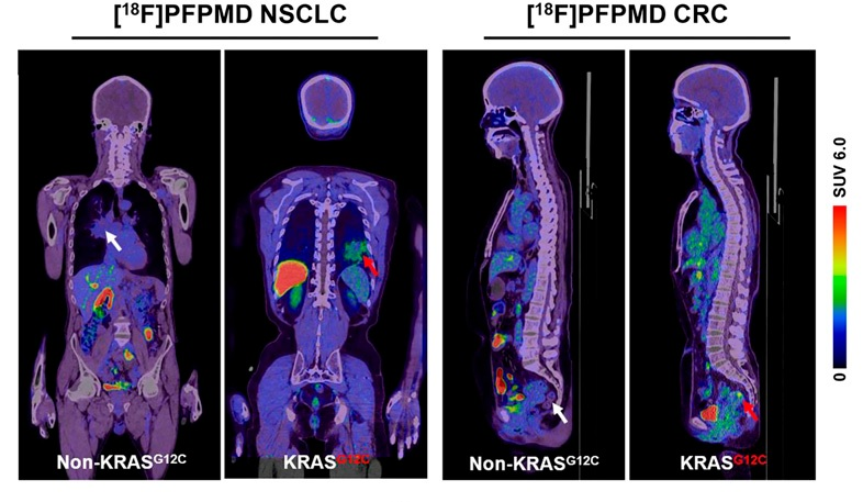 Representative F-18 PFPMD-PET/CT images of non-KRAS-G12C and KRAS-G12C tumors in patients with non-small cell lung cancer (NSCLC) and colorectal cancer (CRC). Image courtesy of the Journal of Nuclear Medicine.