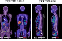 Representative F-18 PFPMD-PET/CT images of non-KRAS-G12C and KRAS-G12C tumors in patients with non-small cell lung cancer (NSCLC) and colorectal cancer (CRC). Image courtesy of the Journal of Nuclear Medicine.