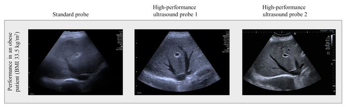 Scan of the liver of an obese patient. The image quality of the standard ultrasound probe (left) is significantly poorer than that of the high-performance probes (center and left). Image and caption courtesy of Universit&auml;t Leipzig.