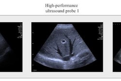 Scan of the liver of an obese patient. The image quality of the standard ultrasound probe (left) is significantly poorer than that of the high-performance probes (center and left). Image and caption courtesy of Universität Leipzig.
