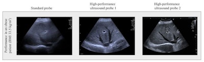 Scan of the liver of an obese patient. The image quality of the standard ultrasound probe (left) is significantly poorer than that of the high-performance probes (center and left). Image and caption courtesy of Universität Leipzig.