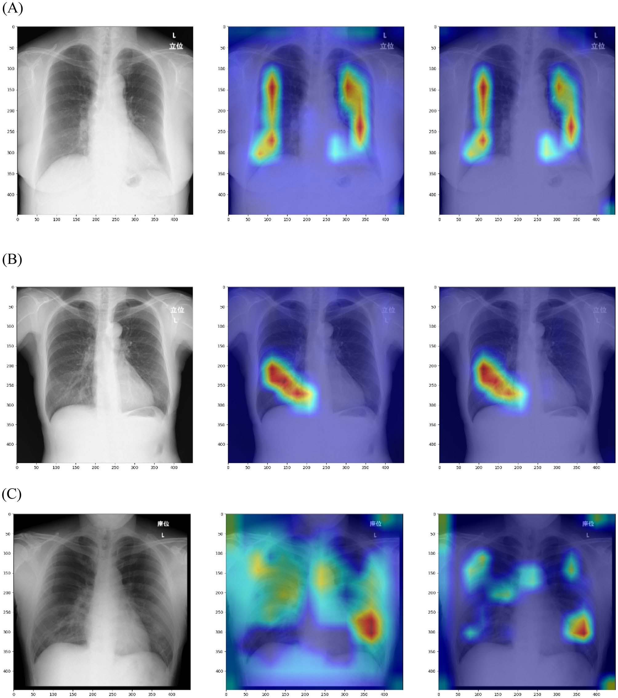 Results of Grad-CAM and Grad-CAM++ for the deep-learning model: (A) normal, (B) pneumonia, and (C) COVID-19. Left column, original chest x-ray image; middle column, result of Grad-CAM; right column, results of Grad-CAM++ .