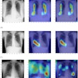 Results of Grad-CAM and Grad-CAM++ for the deep-learning model: (A) normal, (B) pneumonia, and (C) COVID-19. Left column, original chest x-ray image; middle column, result of Grad-CAM; right column, results of Grad-CAM++ .