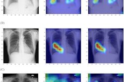 Results of Grad-CAM and Grad-CAM++ for the deep-learning model: (A) normal, (B) pneumonia, and (C) COVID-19. Left column, original chest x-ray image; middle column, result of Grad-CAM; right column, results of Grad-CAM++ .