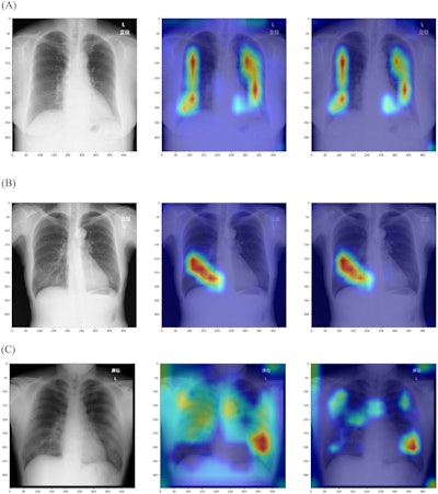 Results of Grad-CAM and Grad-CAM++ for the deep-learning model: (A) normal, (B) pneumonia, and (C) COVID-19. Left column, original chest x-ray image; middle column, result of Grad-CAM; right column, results of Grad-CAM++ .