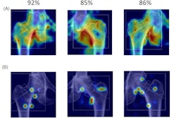 Visualization of EigenGradCAM (A) and GradCAM results (B) illustrating association between fracture group classification and DXA image features for moderate fracture risk subjects. Given are the three highest confidence images with labels predicted for correct classifications, which ranged from 85% to 92% confidence. Image courtesy of JBMR Plus.