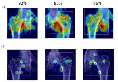 Visualization of EigenGradCAM (A) and GradCAM results (B) illustrating association between fracture group classification and DXA image features for moderate fracture risk subjects. Given are the three highest confidence images with labels predicted for correct classifications, which ranged from 85% to 92% confidence. Image courtesy of JBMR Plus.