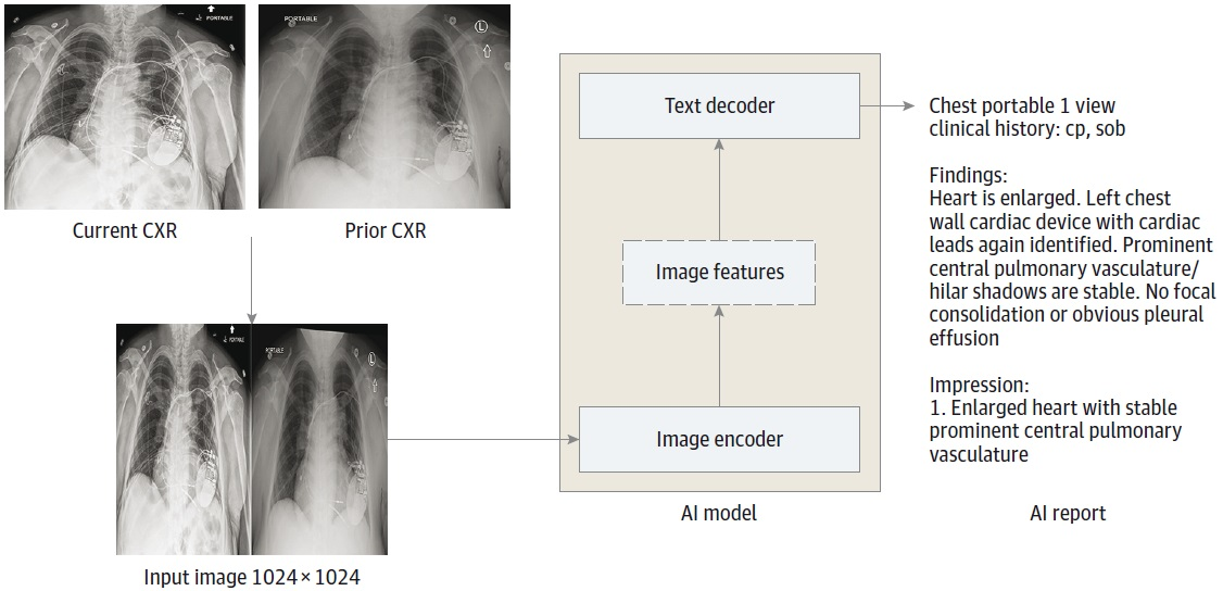 The AI model is an encoder-decoder model trained to generate a text report given a chest x-ray and most recent comparison (anterior-posterior or posterior-anterior view only). The vision encoder weights were initialized from Vision Transformer (ViT) base and the text decoder weights were initialized from Robustly Optimized BERT Pretraining Approach (RoBERTa) base before training for 30 epochs on a data set of 900,000 chest x-rays (CXRs). cp indicates chest pain; sob = shortness of breath. Image courtesy of JAMA Open Network.