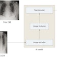 The AI model is an encoder-decoder model trained to generate a text report given a chest x-ray and most recent comparison (anterior-posterior or posterior-anterior view only). The vision encoder weights were initialized from Vision Transformer (ViT) base and the text decoder weights were initialized from Robustly Optimized BERT Pretraining Approach (RoBERTa) base before training for 30 epochs on a data set of 900,000 chest x-rays (CXRs). cp indicates chest pain; sob = shortness of breath. Image courtesy of JAMA Open Network.