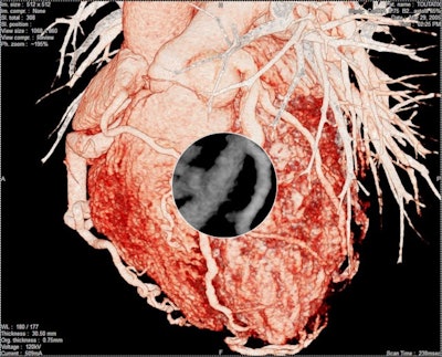 LifeVoxel's platform provides adaptive visualization of the heart using AI for direct physician use, according to the company. An example is shown here of a left anterior view with focus on left anterior descending artery (LAD) with magnified multiplanar reformatting (MPR) view demonstrating focal narrowing of the LAD proximal to midsection. Image courtesy of LifeVoxel.com