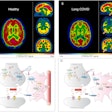 Hypometabolism detected with F-18 FDG-PET in long-COVID patients: putative astrocyte dysfunction and glutamatergic dysregulation. (A) PET scan of a healthy subject. (B) PET scan of a long COVID patient. Hypometabolic areas are indicated with arrows. (C) A diagram showing a healthy condition in which an astrocyte has a normal capacity to take up glutamate and recycle it to sustain glutamatergic neurotransmission, giving rise to normal glucose utilization and lactate production to ensure adequate neuronal energy supply. (D) A diagram showing a long COVID condition in which an astrocyte has reduced glutamate uptake capacity, leading to reduced glutamate recycling, lower glucose utilization (observed with F-18 FDG-PET as hypometabolism) and lower lactate production, dysregulating glutamatergic neurotransmission, and possibly endangering neuronal survival.