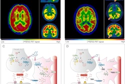 Hypometabolism detected with F-18 FDG-PET in long-COVID patients: putative astrocyte dysfunction and glutamatergic dysregulation. (A) PET scan of a healthy subject. (B) PET scan of a long COVID patient. Hypometabolic areas are indicated with arrows. (C) A diagram showing a healthy condition in which an astrocyte has a normal capacity to take up glutamate and recycle it to sustain glutamatergic neurotransmission, giving rise to normal glucose utilization and lactate production to ensure adequate neuronal energy supply. (D) A diagram showing a long COVID condition in which an astrocyte has reduced glutamate uptake capacity, leading to reduced glutamate recycling, lower glucose utilization (observed with F-18 FDG-PET as hypometabolism) and lower lactate production, dysregulating glutamatergic neurotransmission, and possibly endangering neuronal survival.