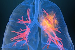 Lung Cancer2 400