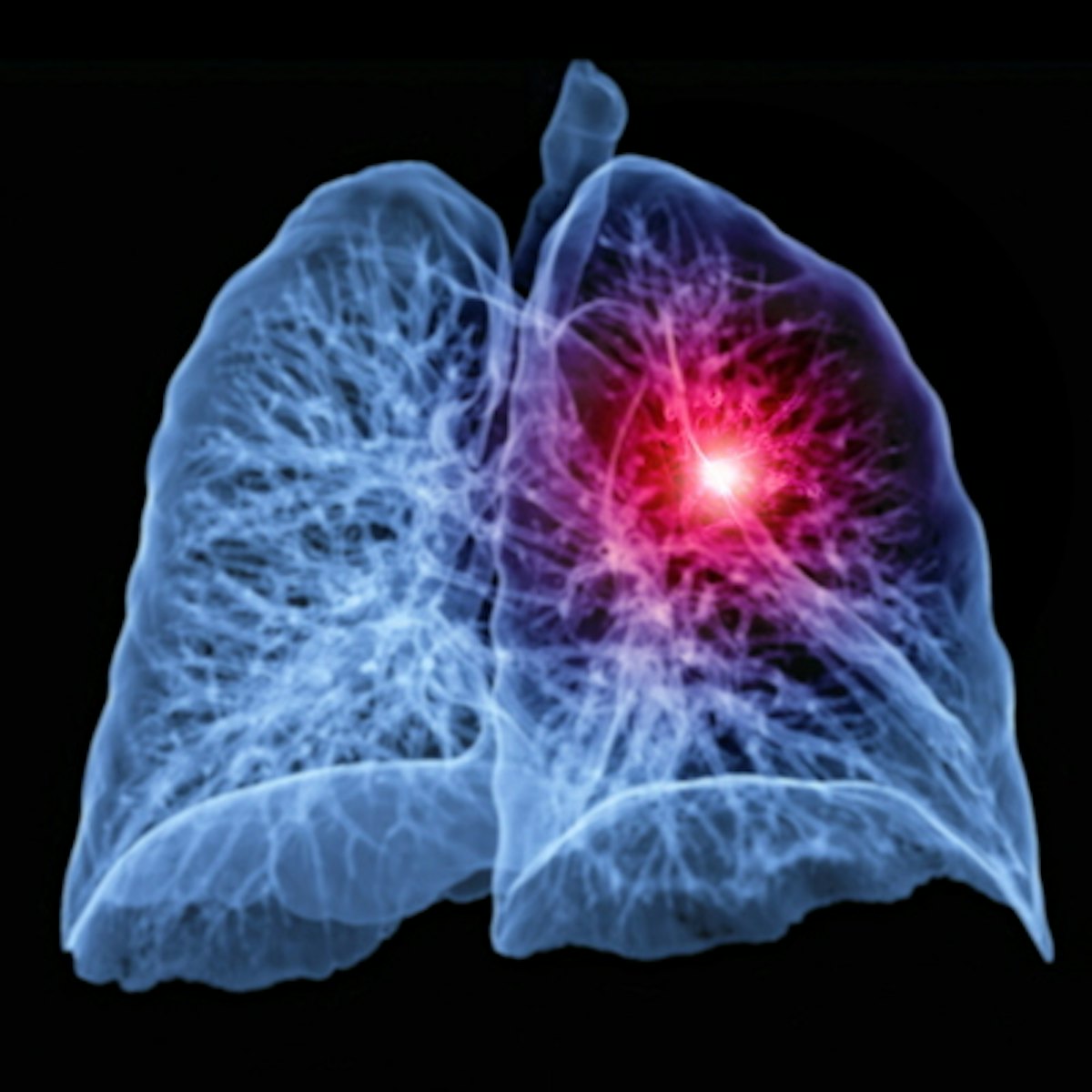 Risk-based lung cancer screening mitigate healthcare disparities