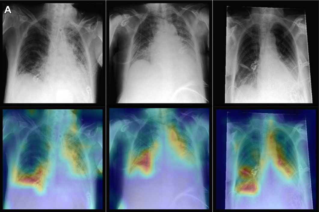 Representative radiographs (top), acquired in anteroposterior projection in the supine position, and corresponding attention maps (bottom). (A) Images show main diagnostic findings of the internal data set in a 49-year-old male patient with congestion, pneumonic infiltrates, and effusion (left); a 64-year-old male patient with congestion, pneumonic infiltrates, and effusion (middle); and a 69-year-old female patient with effusion (right). Image courtesy of Radiology.