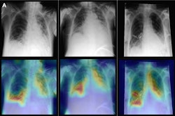Representative radiographs (top), acquired in anteroposterior projection in the supine position, and corresponding attention maps (bottom). (A) Images show main diagnostic findings of the internal data set in a 49-year-old male patient with congestion, pneumonic infiltrates, and effusion (left); a 64-year-old male patient with congestion, pneumonic infiltrates, and effusion (middle); and a 69-year-old female patient with effusion (right). Image courtesy of Radiology.