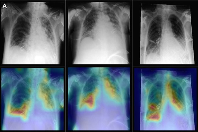 Representative radiographs (top), acquired in anteroposterior projection in the supine position, and corresponding attention maps (bottom). (A) Images show main diagnostic findings of the internal data set in a 49-year-old male patient with congestion, pneumonic infiltrates, and effusion (left); a 64-year-old male patient with congestion, pneumonic infiltrates, and effusion (middle); and a 69-year-old female patient with effusion (right). Image courtesy of Radiology.