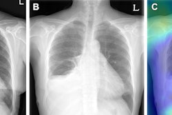 Example of triage of no change in a pair of chest radiographs in the emergency department. (A) Baseline posteroanterior chest radiograph in a 63-year-old female patient shows a small amount of left (L) pleural effusion and partial atelectasis of the right middle lobe. (B) Follow-up posteroanterior chest radiograph obtained in the same patient 1 day later shows no significant change. (C) Gradient-weighted class activation map shows the algorithm determined no change in the image pair, without relevant highlighting, as the highlighted area is located over the gastroesophageal junction. Image courtesy of Radiology.