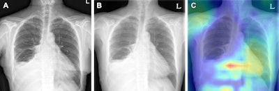 Пример сортировки без изменений на паре рентгенограмм грудной клетки в отделении неотложной помощи.  (А) На исходной задне-передней рентгенограмме грудной клетки у 63-летней пациентки выявлен небольшой объем левого (L) плеврального выпота и частичный ателектаз правой средней доли.  (B) Последующая рентгенограмма грудной клетки в задне-передней части, полученная у того же пациента через 1 день, не выявила существенных изменений.  (C) Карта активации градиентно-взвешенного класса показывает, что алгоритм не определил никаких изменений в паре изображений, без соответствующего выделения, поскольку выделенная область расположена над желудочно-пищеводным переходом.  Изображение предоставлено Радиологией.