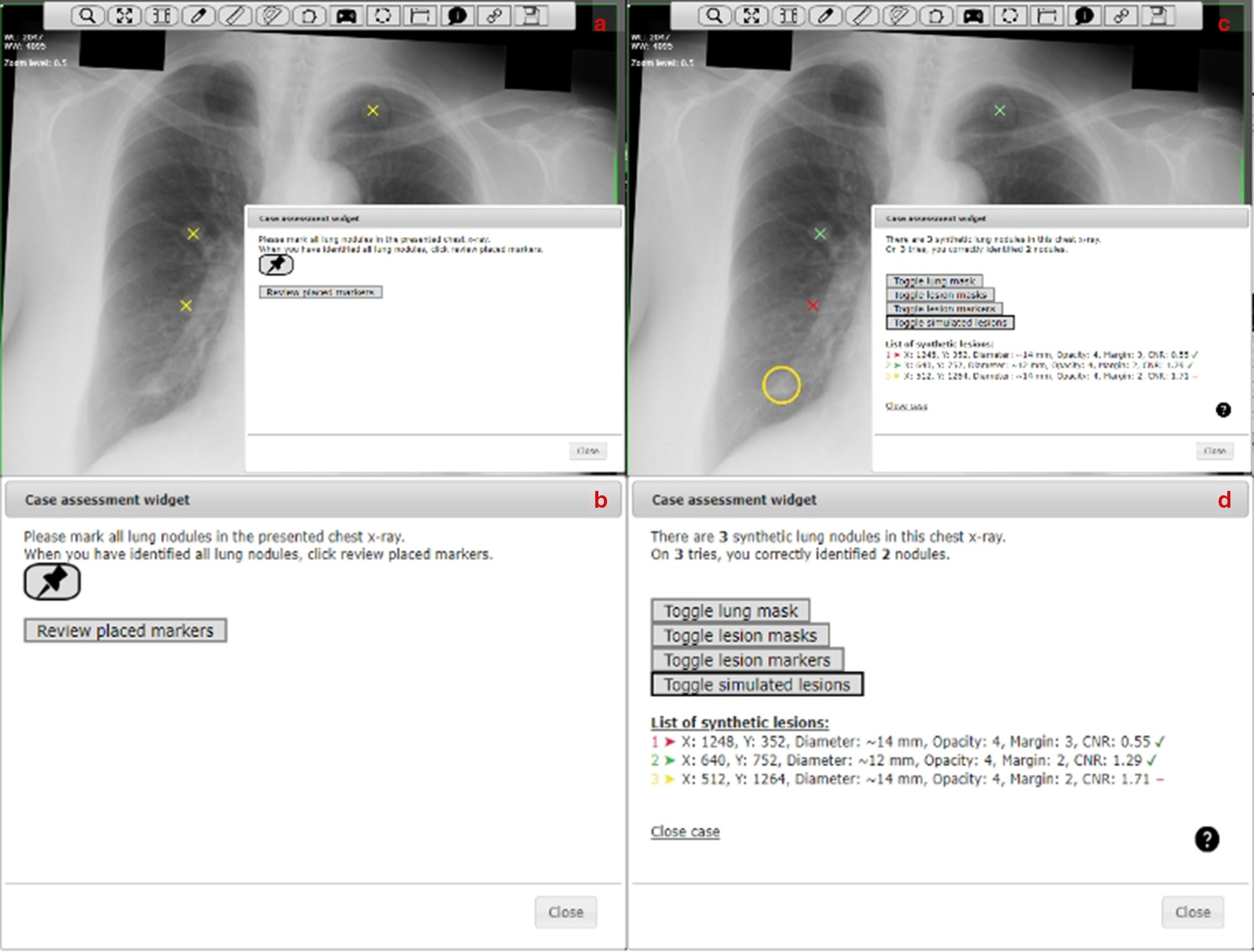 Screenshots of the imaging viewer interface before (a-b) and after (c-d) having clicked &ldquo;Review placed markers.&rdquo; The &ldquo;Case assessment widget&rdquo; has been magnified in (b,d). One marker was incorrectly placed (c), which is signified with a red cross. One nodule was not identified (c) and was highlighted by a yellow circle through the mouse over function in the &ldquo;List of synthetic lesions.&rdquo; Image courtesy of the British Journal of Radiology.