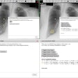 Screenshots of the imaging viewer interface before (a-b) and after (c-d) having clicked “Review placed markers.” The “Case assessment widget” has been magnified in (b,d). One marker was incorrectly placed (c), which is signified with a red cross. One nodule was not identified (c) and was highlighted by a yellow circle through the mouse over function in the “List of synthetic lesions.” Image courtesy of the British Journal of Radiology.
