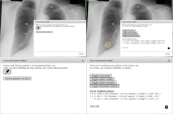 Screenshots of the imaging viewer interface before (a-b) and after (c-d) having clicked “Review placed markers.” The “Case assessment widget” has been magnified in (b,d). One marker was incorrectly placed (c), which is signified with a red cross. One nodule was not identified (c) and was highlighted by a yellow circle through the mouse over function in the “List of synthetic lesions.” Image courtesy of the British Journal of Radiology.