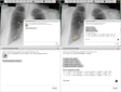 Screenshots of the imaging viewer interface before (a-b) and after (c-d) having clicked “Review placed markers.” The “Case assessment widget” has been magnified in (b,d). One marker was incorrectly placed (c), which is signified with a red cross. One nodule was not identified (c) and was highlighted by a yellow circle through the mouse over function in the “List of synthetic lesions.” Image courtesy of the British Journal of Radiology.