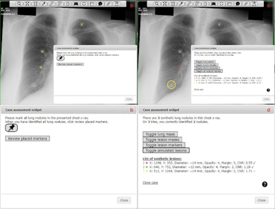 Screenshots of the imaging viewer interface before (a-b) and after (c-d) having clicked “Review placed markers.” The “Case assessment widget” has been magnified in (b,d). One marker was incorrectly placed (c), which is signified with a red cross. One nodule was not identified (c) and was highlighted by a yellow circle through the mouse over function in the “List of synthetic lesions.” Image courtesy of the British Journal of Radiology.