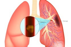 Pulmonary Embolism Illustration 400