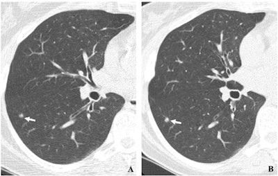 (A, B) Two annual repeat low-dose CT scans in a woman who was 60 years old at baseline enrollment in 1999. At baseline enrollment, she was currently smoking and had a 30-pack-year smoking history. No nodules were identified on baseline low-dose CT scans. On the sixth annual low-dose CT scan (B), a right lower lobe solid nodule (arrow) measuring 4.5 mm in maximum diameter was identified. The nodule could be identified in retrospect on the prior annual CT scan (arrow in A), when it measured 2 mm in maximum diameter. Estimated tumor volume doubling time was 161 days. Lobectomy was performed two months later, and diagnosis of stage 1aN0M0 moderately differentiated adenocarcinoma measuring 6 mm in maximum diameter was made. Expert pathologic panel review (22) of the pathologic specimen updated the diagnosis to adenocarcinoma with mixed subtype (80% acinar, 20% bronchoalveolar carcinoma components) with 5 mm of invasion. Images and caption courtesy of the RSNA.