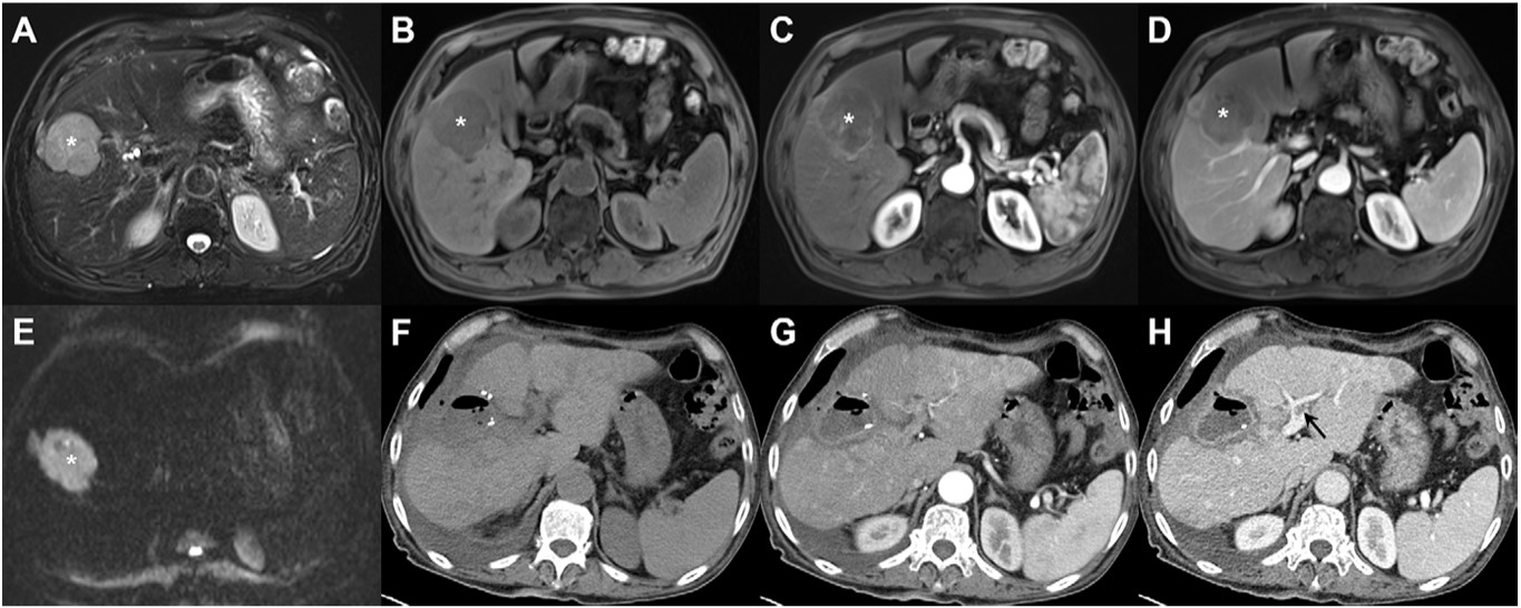Preoperative axial extracellular contrast agent-enhanced (A-E) MRI and (F-H) follow-up CT images in a 71-year-old male patient with chronic hepatitis B and a serum neutrophil count of 4.2 &times; 109/L. A 5.6-cm mass with a 1.9-cm satellite nodule was detected in segments V and VIII. (A) The mass (asterisks, A-E) shows mild-to-moderate hyperintensity on T2-weighted images, (B) hypointensity on T1-weighted noncontrast-enhanced images, (C) less than 50% hyperenhancement on late arterial phase images, (D) nonperipheral washout and incomplete enhancing capsule on portal venous phase images, and (E) marked diffusion restriction on diffusion-weighted images (b = 800 sec/mm2). The mass was confirmed at histopathologic analysis as moderately differentiated hepatocellular carcinoma with microvascular invasion. With an advanced-stage recurrence after resection score of 19.8 points (4.2 + 5.6 + 10), this patient was assigned to the high-risk group (&ge;15 points) for advanced-stage recurrence. At follow-up, (F) noncontrast-enhanced, (G) arterial phase, and (H) portal venous phase CT images acquired at day 70 after surgery show multifocal intrahepatic recurrence and tumor thrombus in the left portal vein (black arrow, H). Images and caption courtesy of the RSNA.