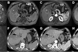 Preoperative axial extracellular contrast agent-enhanced (A-E) MRI and (F-H) follow-up CT images in a 71-year-old male patient with chronic hepatitis B and a serum neutrophil count of 4.2 × 109/L. A 5.6-cm mass with a 1.9-cm satellite nodule was detected in segments V and VIII. (A) The mass (asterisks, A-E) shows mild-to-moderate hyperintensity on T2-weighted images, (B) hypointensity on T1-weighted noncontrast-enhanced images, (C) less than 50% hyperenhancement on late arterial phase images, (D) nonperipheral washout and incomplete enhancing capsule on portal venous phase images, and (E) marked diffusion restriction on diffusion-weighted images (b = 800 sec/mm2). The mass was confirmed at histopathologic analysis as moderately differentiated hepatocellular carcinoma with microvascular invasion. With an advanced-stage recurrence after resection score of 19.8 points (4.2 + 5.6 + 10), this patient was assigned to the high-risk group (≥15 points) for advanced-stage recurrence. At follow-up, (F) noncontrast-enhanced, (G) arterial phase, and (H) portal venous phase CT images acquired at day 70 after surgery show multifocal intrahepatic recurrence and tumor thrombus in the left portal vein (black arrow, H). Images and caption courtesy of the RSNA.