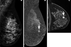 A 47-year-old female participant with a suspicious mass noted at screening tomosynthesis and subsequent diagnostic ultrasound was recruited for contrast-enhanced mammography (CEM) and MRI. (A) No abnormality was noted on the conventional 2D mammogram showing dense breast tissue. A mass (arrows) was clearly observed on (B) the recombined CEM image and (C) the MRI scan. Both images show marked background parenchymal enhancement. Biopsy confirmed a 1.1-cm grade 2 invasive ductal carcinoma (estrogen receptor- and progesterone receptor-positive, human epidermal growth factor receptor 2-negative). Image courtesy of Radiology.