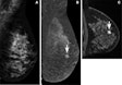 A 47-year-old female participant with a suspicious mass noted at screening tomosynthesis and subsequent diagnostic ultrasound was recruited for contrast-enhanced mammography (CEM) and MRI. (A) No abnormality was noted on the conventional 2D mammogram showing dense breast tissue. A mass (arrows) was clearly observed on (B) the recombined CEM image and (C) the MRI scan. Both images show marked background parenchymal enhancement. Biopsy confirmed a 1.1-cm grade 2 invasive ductal carcinoma (estrogen receptor- and progesterone receptor-positive, human epidermal growth factor receptor 2-negative). Image courtesy of Radiology.