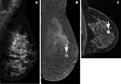 A 47-year-old female participant with a suspicious mass noted at screening tomosynthesis and subsequent diagnostic ultrasound was recruited for contrast-enhanced mammography (CEM) and MRI. (A) No abnormality was noted on the conventional 2D mammogram showing dense breast tissue. A mass (arrows) was clearly observed on (B) the recombined CEM image and (C) the MRI scan. Both images show marked background parenchymal enhancement. Biopsy confirmed a 1.1-cm grade 2 invasive ductal carcinoma (estrogen receptor- and progesterone receptor-positive, human epidermal growth factor receptor 2-negative). Image courtesy of Radiology.