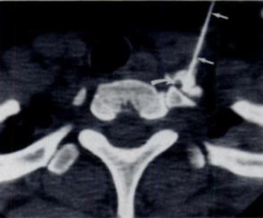 CT-guided stellate ganglion injection. Image courtesy of the RSNA.
